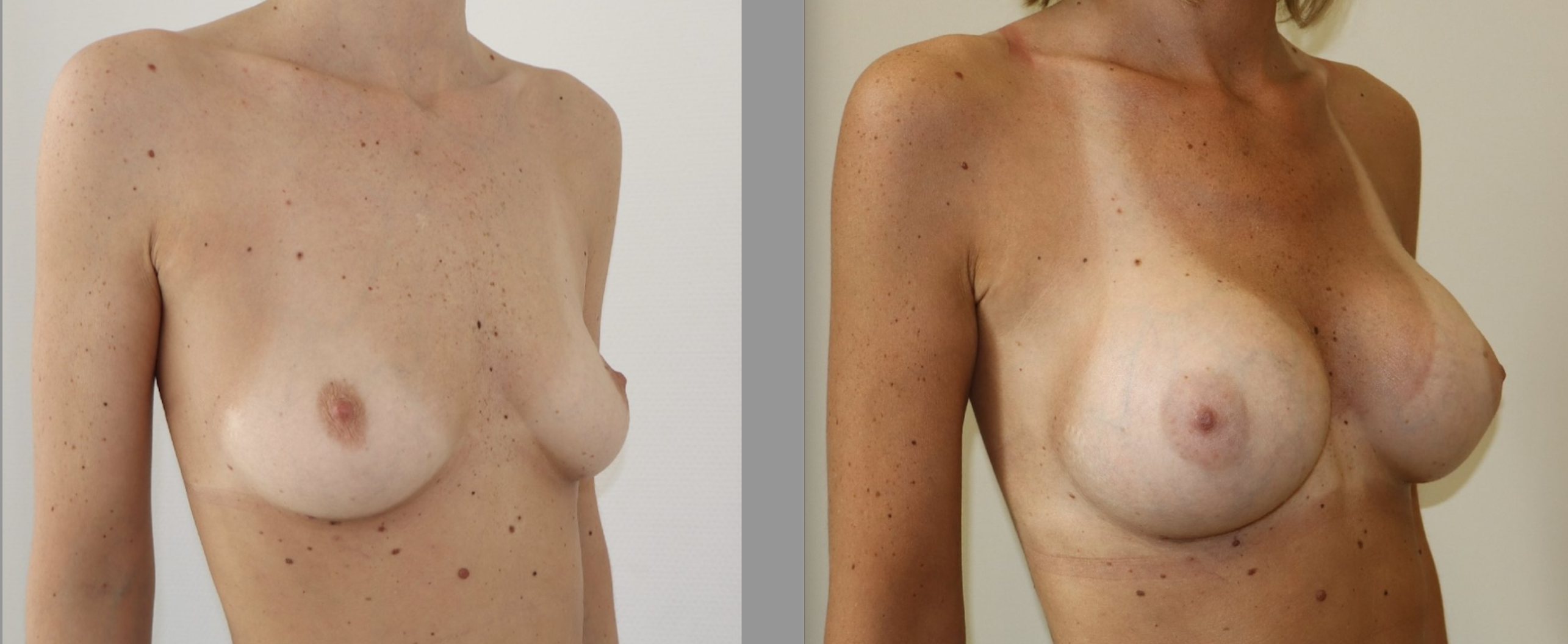 Avant/Après prothèses mammaires